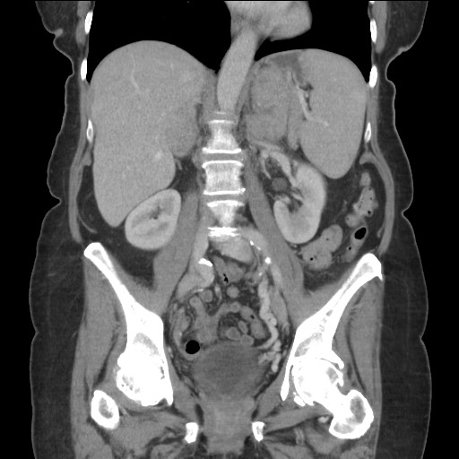 Bilateral adrenal granulocytic sarcomas (chloromas) (Radiopaedia 78375-91007 B 54).jpg