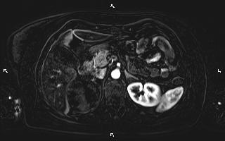 Bilateral adrenal myelolipoma (Radiopaedia 63058-71537 I 38).jpg
