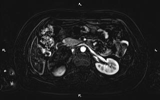 Bilateral adrenal myelolipoma (Radiopaedia 63058-71537 I 45).jpg