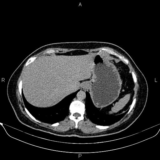 Bilateral benign adrenal adenomas (Radiopaedia 86912-103124 Axial C+ delayed 8).jpg