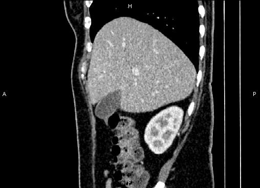 Bilateral benign adrenal adenomas (Radiopaedia 86912-103124 E 22).jpg