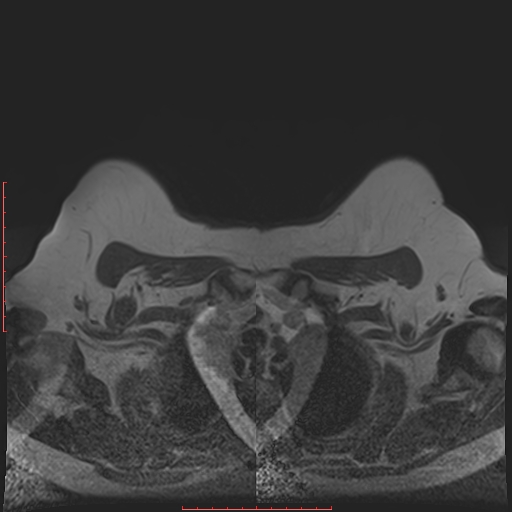 File:Bilateral breast implant rupture (Radiopaedia 24761-25027 T1 3).jpg