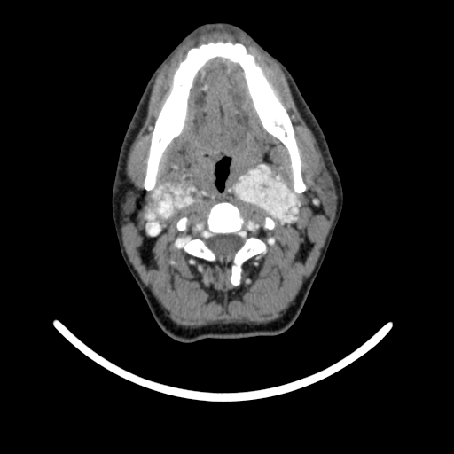 File:Bilateral carotid body tumors (Radiopaedia 52899-58827 A 24).jpg