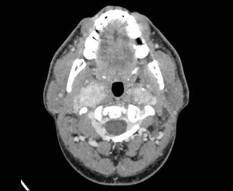 Bilateral carotid body tumors (Radiopaedia 61841-69870 Axial Post contrast 26).jpg