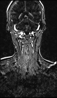 Bilateral carotid body tumors and right glomus jugulare tumor (Radiopaedia 20024-20060 MRA 130).jpg