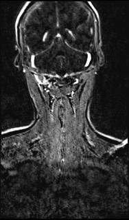 File:Bilateral carotid body tumors and right glomus jugulare tumor (Radiopaedia 20024-20060 MRA 132).jpg