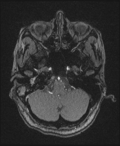 File:Bilateral carotid body tumors and right jugular paraganglioma (Radiopaedia 20024-20060 Axial 151).jpg