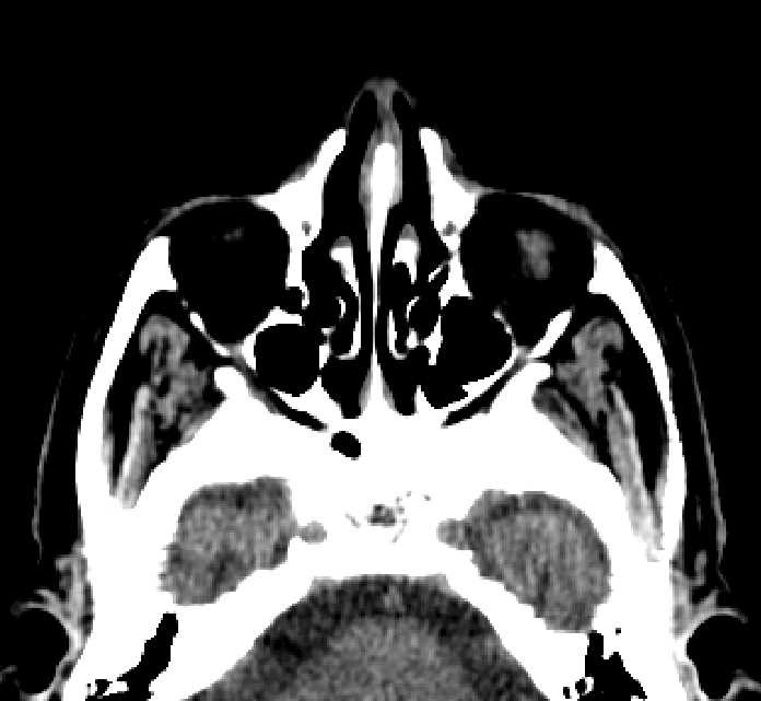 Bilateral ectopia lentis (Radiopaedia 89889-107013 Axial non-contrast 71).jpg