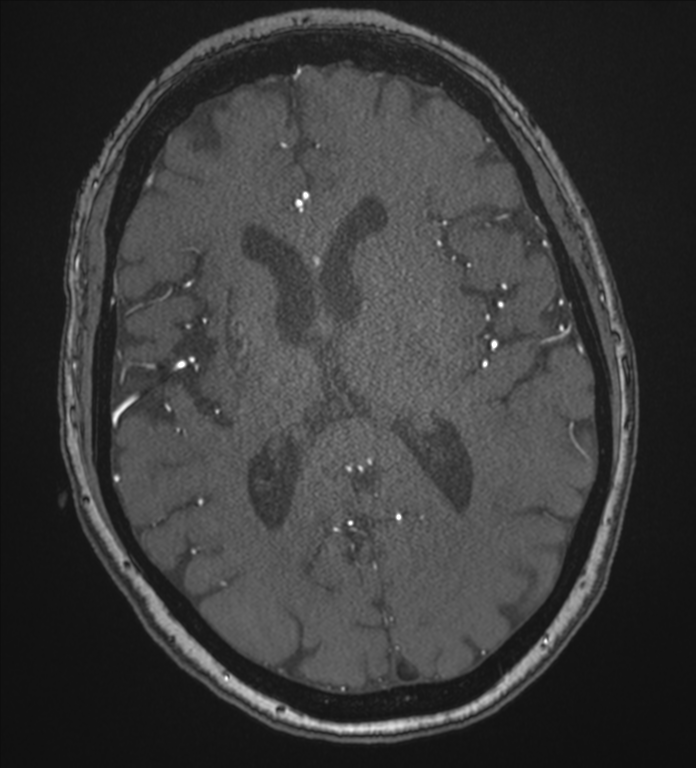 Bilateral fetal posterior communicating arteries (Radiopaedia 41286-44102 Axial MRA 123).png