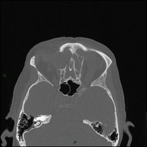 Bilateral frontal mucoceles (Radiopaedia 82352-96454 Axial bone window 127).jpg