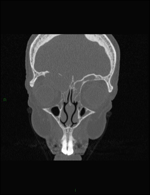 Bilateral frontal mucoceles (Radiopaedia 82352-96454 Coronal 97).jpg