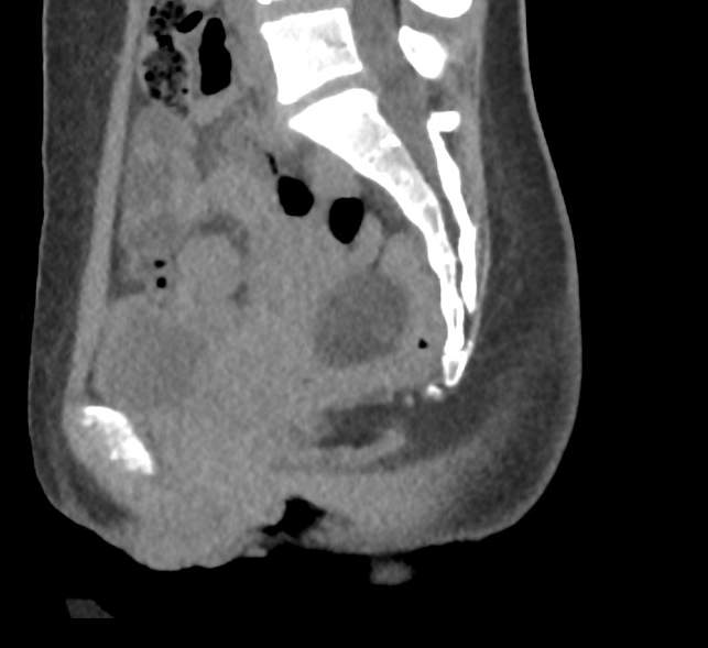 File:Bilateral mature cystic ovarian teratoma (Radiopaedia 88821-105592 D 32).jpg