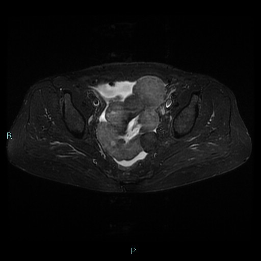 File:Bilateral ovarian fibroma (Radiopaedia 44568-48293 Axial STIR 15).jpg