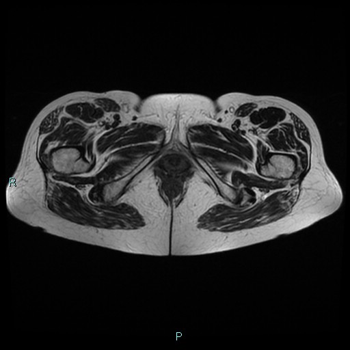 File:Bilateral ovarian fibroma (Radiopaedia 44568-48293 Axial T2 30).jpg
