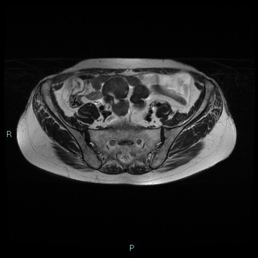 File:Bilateral ovarian fibroma (Radiopaedia 44568-48293 Axial T2 6).jpg