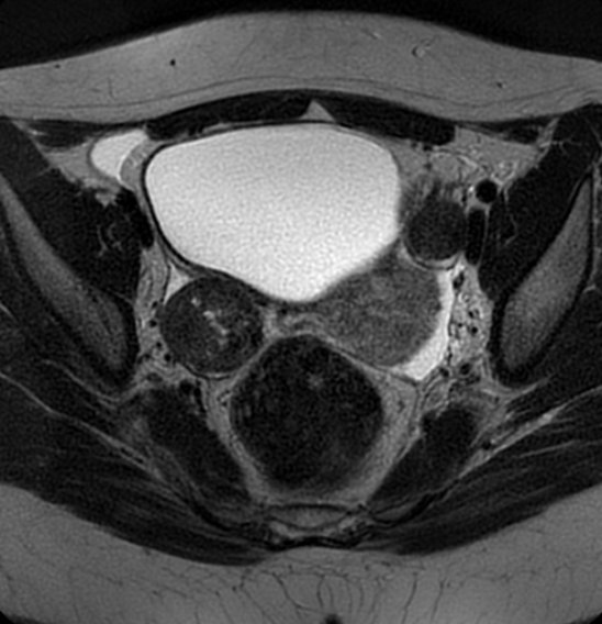 File:Bilateral ovarian fibrothecomas - adolescent (Radiopaedia 86604-102707 Axial T2 23).jpg