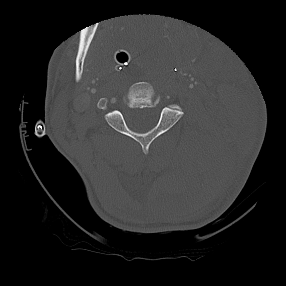 Bilateral perched facets with cord injury (Radiopaedia 45587-49713 Axial bone window 41).jpg