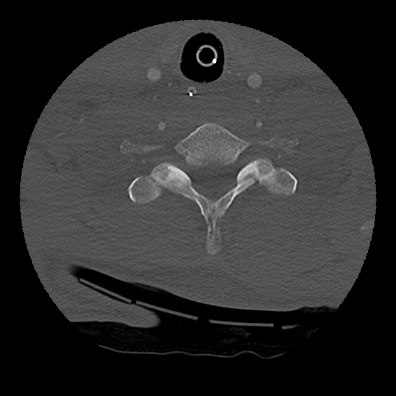 Bilateral perched facets with cord injury (Radiopaedia 45587-49713 Axial bone window 87).jpg
