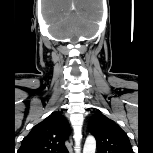 Bilateral peritonsillar abscess (Radiopaedia 85065-100610 Coronal 54).jpg