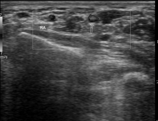 File:Bilateral persistent median artery of the forearm with unilateral bifid median nerve (Radiopaedia 17430-17120 C 1).jpg