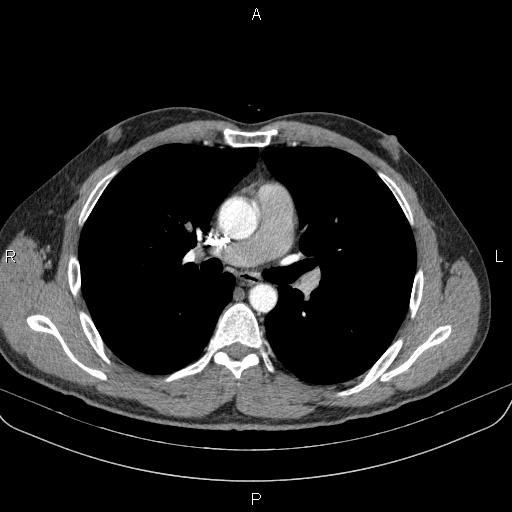 Bilateral pulmonary AVM (Radiopaedia 83134-97505 A 33).jpg