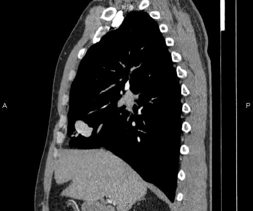 Bilateral pulmonary AVM (Radiopaedia 83134-97505 D 47).jpg
