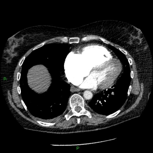 Bilateral pulmonary emboli (Radiopaedia 32700-33669 Axial C+ CTPA 76).jpg