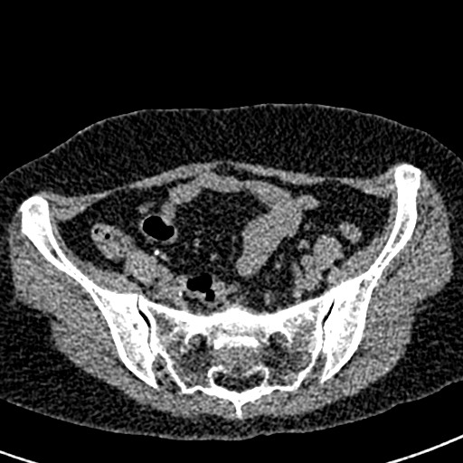 Bilateral staghorn calculi (Radiopaedia 59475-66842 Axial non-contrast 61).jpg