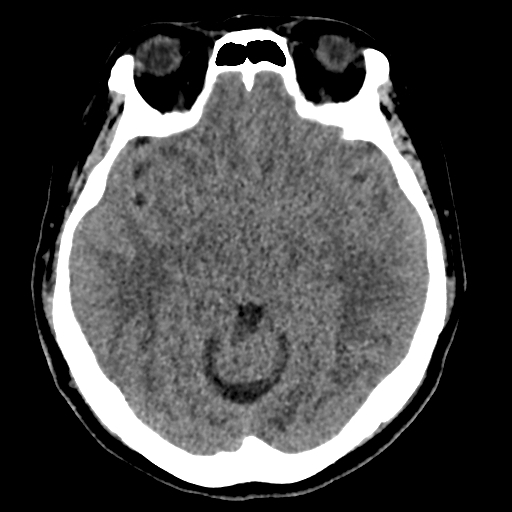 Bilateral subacute subdural hematoma (Radiopaedia 69240-79018 Axial non-contrast 20).jpg