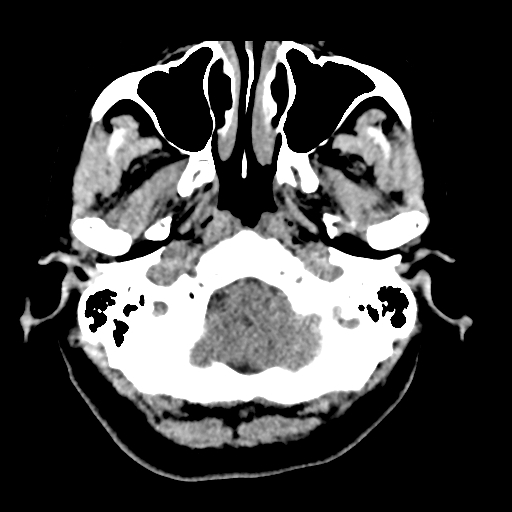 Bilateral subacute subdural hematoma (Radiopaedia 69240-79018 Axial non-contrast 6).jpg