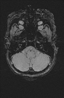 Bilateral subdural hemorrhage and parietal skull fracture (Radiopaedia 26058-26190 Axial SWI 10).png