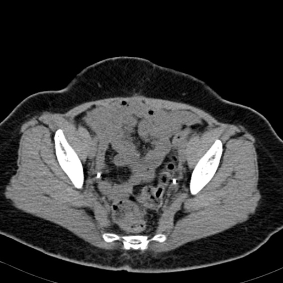 File:Bilateral ureteric stents (Radiopaedia 48795-53825 Axial non-contrast 56).jpg
