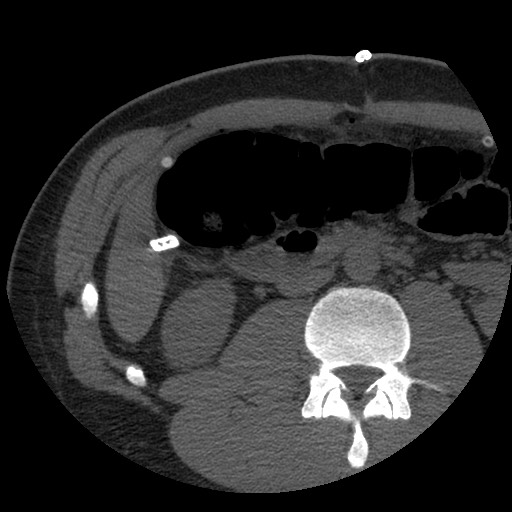 Bile leak from liver traumatic laceration (Radiopaedia 63463-72077 Axial Biliscopin 74).jpg