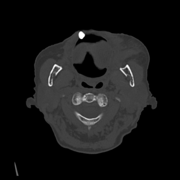 Biparietal osteodystrophy (Radiopaedia 46109-50463 bone window 2).jpg