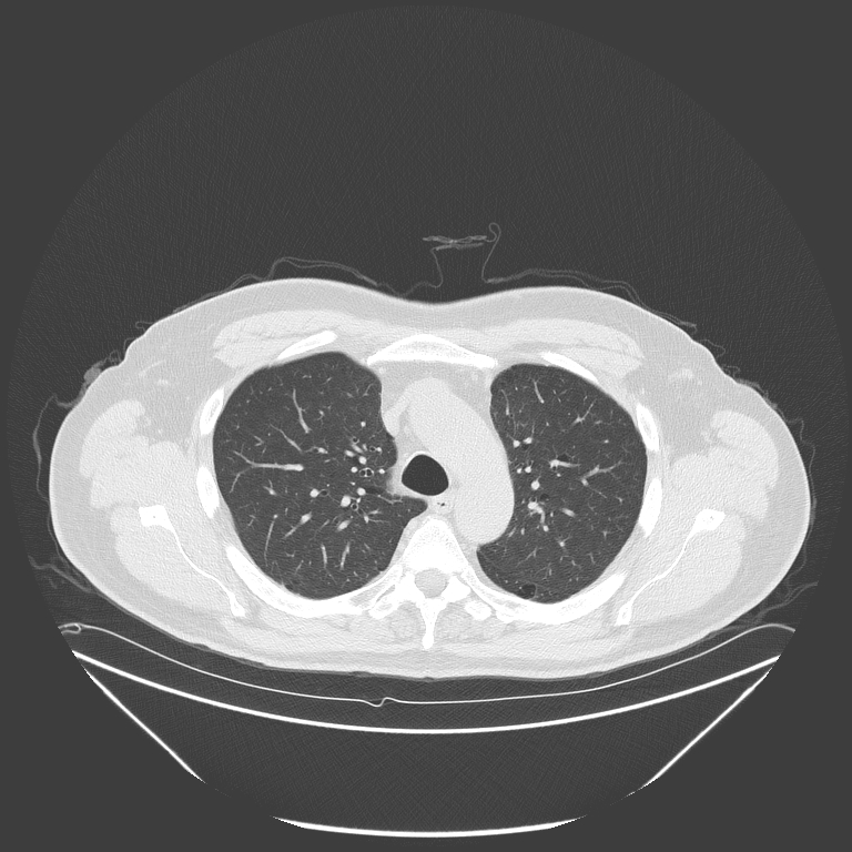 Birt-Hogg-Dubé syndrome (Radiopaedia 52578-58491 Axial lung window 17).jpg