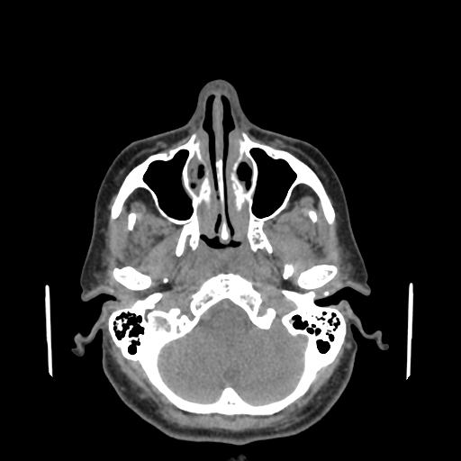 File:Bisphosphonate-related osteonecrosis of the jaw (Radiopaedia 71324-81642 non-contrast 143).jpg