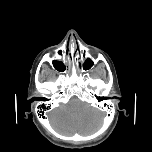 File:Bisphosphonate-related osteonecrosis of the jaw (Radiopaedia 71324-81642 non-contrast 157).jpg