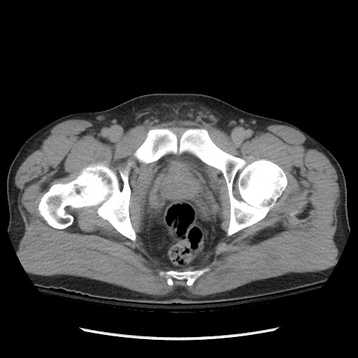 Blunt abdominal trauma with solid organ and musculoskelatal injury with active extravasation (Radiopaedia 68364-77895 Axial C+ delayed 133).jpg