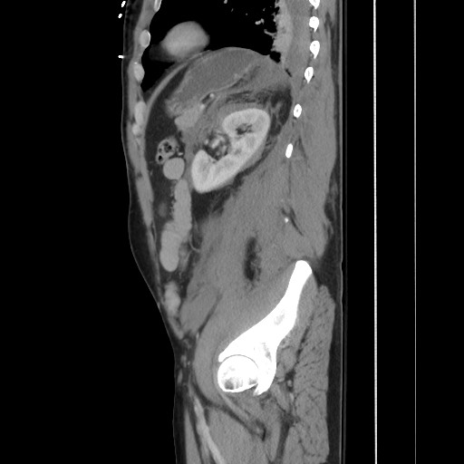 Blunt abdominal trauma with solid organ and musculoskelatal injury with active extravasation (Radiopaedia 68364-77895 C 105).jpg
