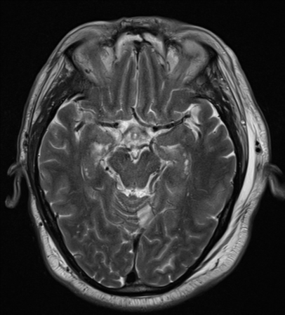 File:Blunt cerebrovascular injury (Radiopaedia 53682-59745 Axial T2 13).png
