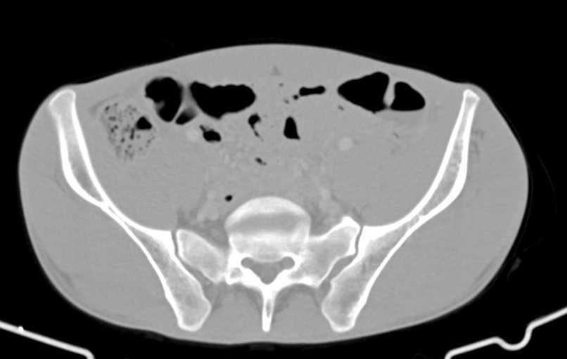 Blunt injury to the small bowel (Radiopaedia 74953-85987 Axial Wide 73).jpg