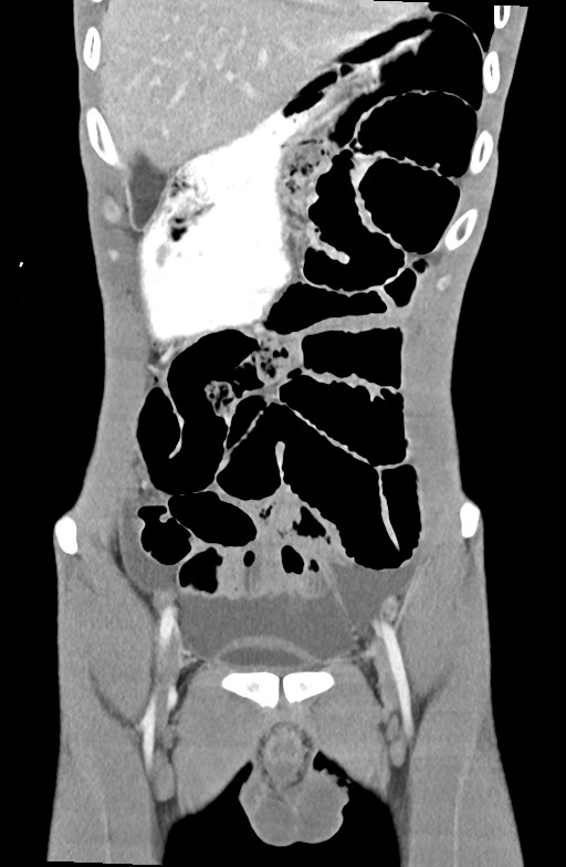 Blunt injury to the small bowel (Radiopaedia 74953-85987 B 26).jpg