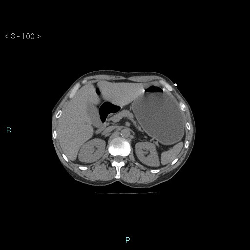 Boerhaave syndrome (Radiopaedia 27683-27897 Axial non-contrast 100).jpg