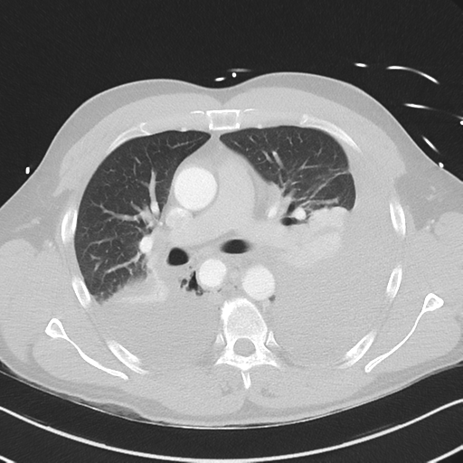 Boerhaave syndrome (Radiopaedia 39382-41661 Axial lung window 24).png