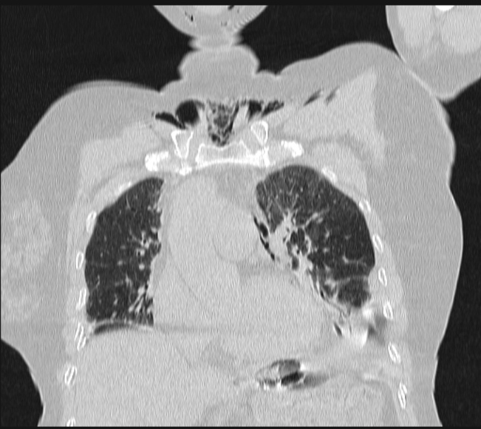 Boerhaave syndrome (Radiopaedia 45644-49799 Coronal lung window 24).jpg