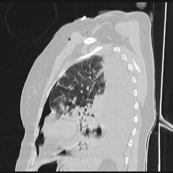 Boerhaave syndrome (Radiopaedia 45644-49799 Sagittal lung window 63).jpg