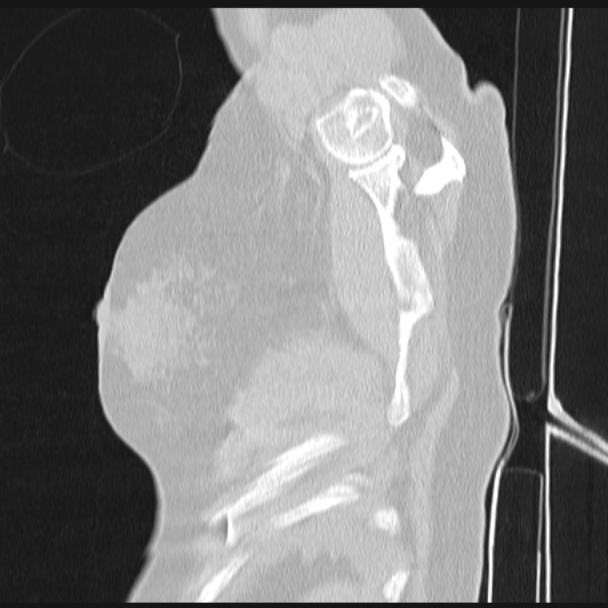 Boerhaave syndrome (Radiopaedia 45644-49799 Sagittal lung window 84).jpg
