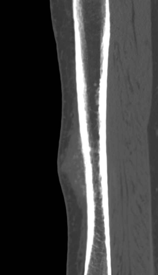 Bone metastasis - tibia (Radiopaedia 57665-64609 Sagittal bone window 65).jpg