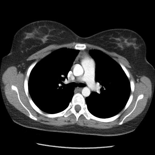 File:Borderline mucinous tumor (ovary) (Radiopaedia 78228-90808 A 19).jpg