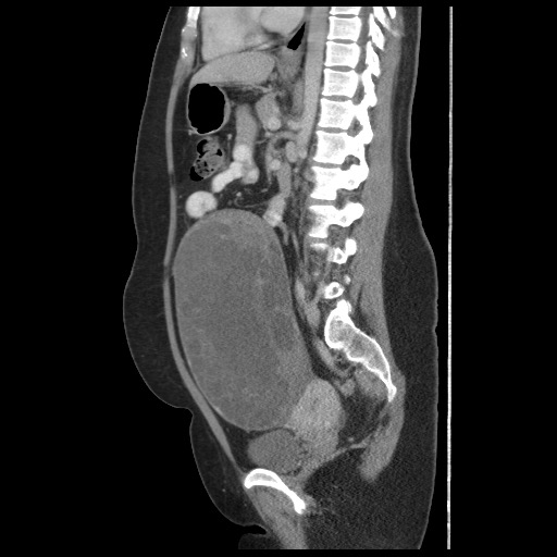 File:Borderline mucinous tumor (ovary) (Radiopaedia 78228-90808 B 39).jpg